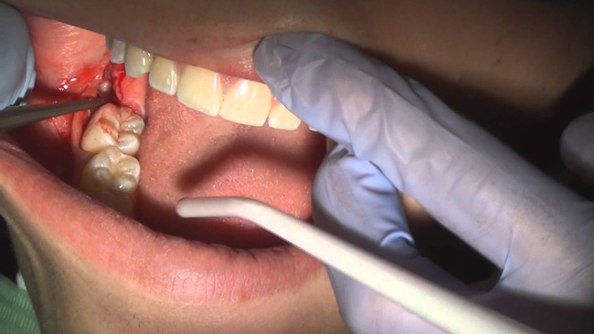 Khi nhổ răng hãy đề phòng những biến chứng gây nguy hiểm tính mạng - Ảnh 1.